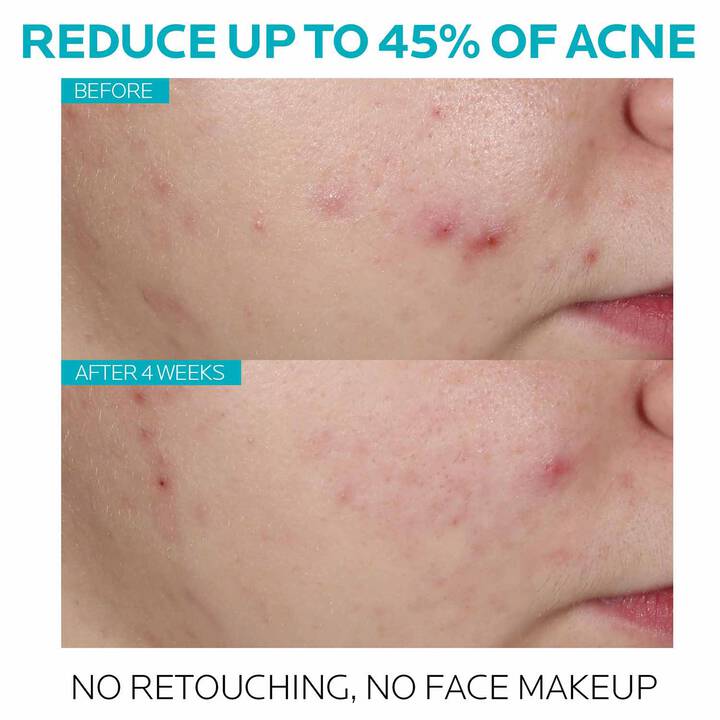 La Roche Posay Effaclar Salicylic Acid Acne Treatment Serum 30ml - sheesha